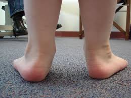 เด็กเท้าแบน เท้าแบน flat foot  แผ่นรองเท้าแบน