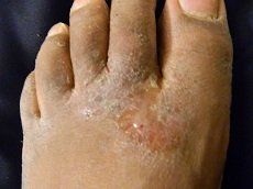 Athletes foot is a fungal infection on the skin