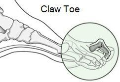 Claw Toe results in the toe sitting in an abnormal position
