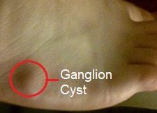 Foot ganglions can appear anywhere on the foot