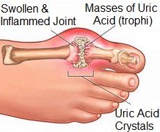 Gout is a common cause of pain and swelling in the big toe