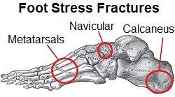 Common sites of foot stress fractures