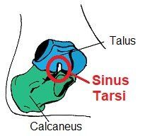 Sinus Tarsi Syndrome causes pain on top of the foot