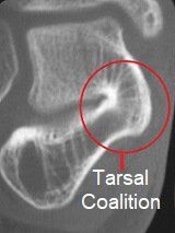 The abnormal joining of tarsal bones known as Tarsal Coalition can cause foot pain